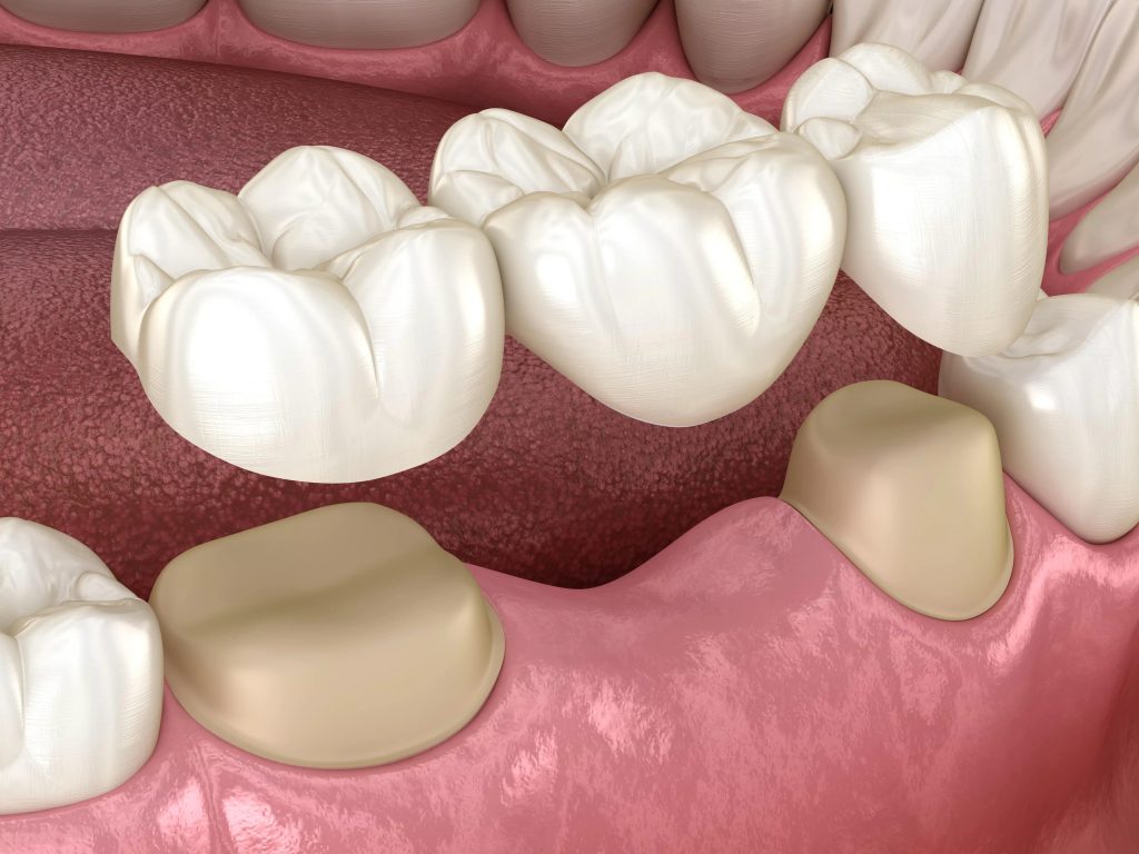 Rouse Hill Dentist dental bridges