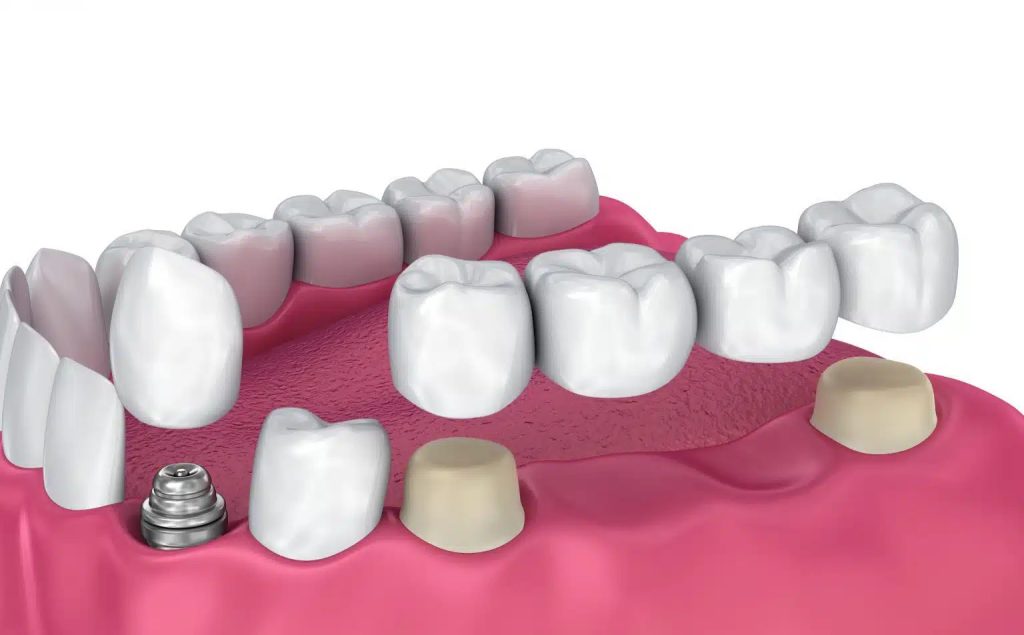 Rouse Hill Dentist dental crown