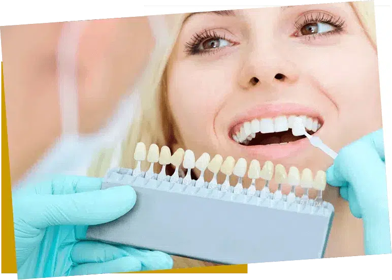 Rouse Hill Dentist Teeth Whiting