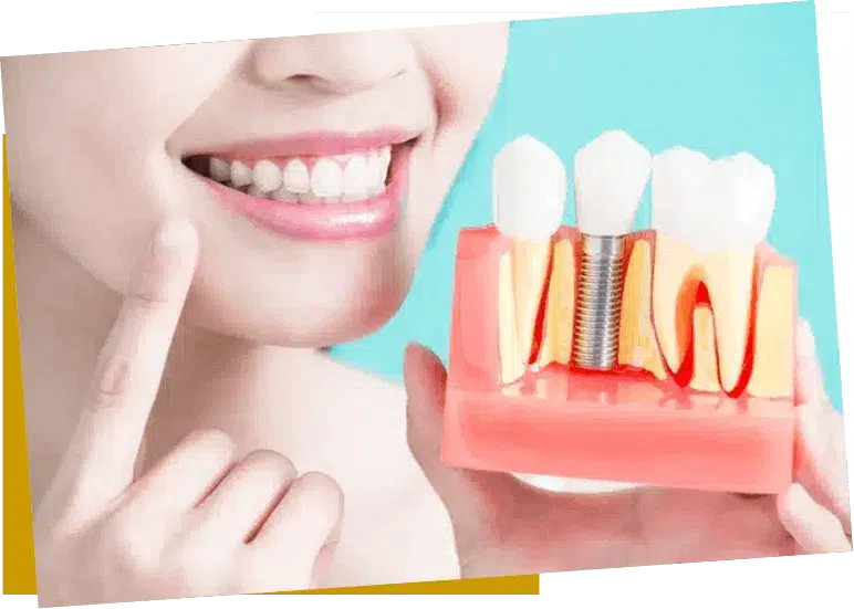 Rouse Hill Dentist Root canal