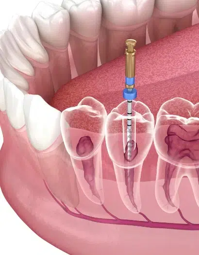 Root Canal