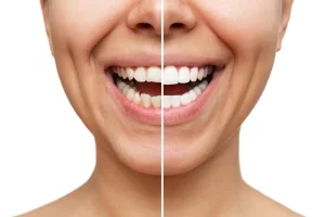 Advantages of Porcelain Dental Veneers
