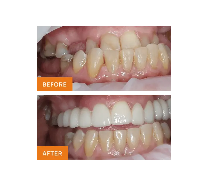 Crowns Bridges Veneers