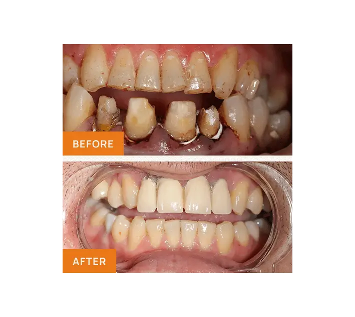 Root Canal Removing Overseas